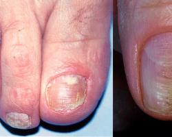 Почему появляются белые полоски на ногтях, фото Почему на ногтях появляются белые полоски лечение