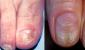 Почему появляются белые полоски на ногтях, фото Почему на ногтях появляются белые полоски лечение